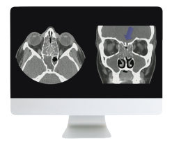 ARRS Cranial Nerve Imaging: From the Least to the Last 2022 ( Videos + CME Questions)