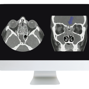 ARRS Cranial Nerve Imaging: From the Least to the Last 2022 ( Videos + CME Questions)