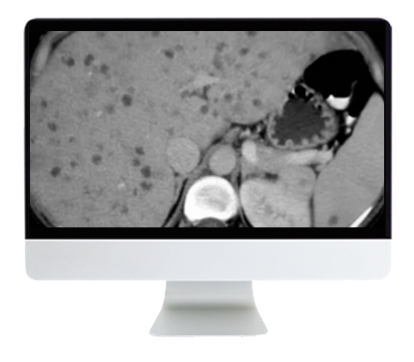 State of the Art Imaging for Chronic Liver Disease 2021 (Videos)