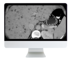 ARRS State of the Art Liver Imaging in Cirrhosis 2021 (Videos)