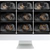 ARRS Crossroads of Computational Science and Musculoskeletal Imaging: Where Machine Magic Can Aid Radiologists 2021 (Videos)