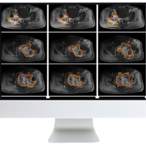 ARRS Crossroads of Computational Science and Musculoskeletal Imaging: Where Machine Magic Can Aid Radiologists 2021 (Videos)