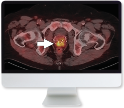 Molecular Imaging and Therapy of Prostate Cancer 2020 (Videos)