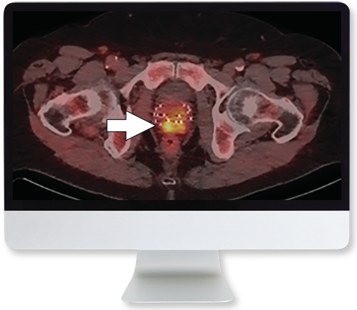 Molecular Imaging and Therapy of Prostate Cancer 2020 (Videos)