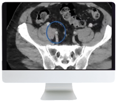 ARRS Venous Disease: Exploration of Advances, Challenges, and Future Directions 2021 (Videos)
