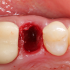 Gidedental Extraction Socket – Preservation/Grafting; Immediate vs Delayed Implants; Pontic Site Development 2020 (Videos)