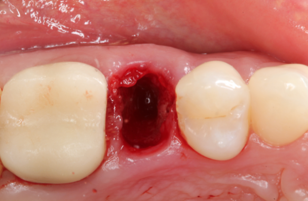 Gidedental Extraction Socket – Preservation/Grafting; Immediate vs Delayed Implants; Pontic Site Development 2020 (Videos)
