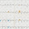 Physician Assistant Care Series – 12 Lead EKG Review (EPUB)