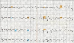Physician Assistant Care Series – 12 Lead EKG Review (EPUB)