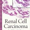 Renal Cell Carcinoma