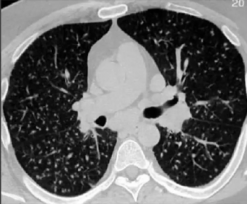 MRIOnline Imaging Mastery Series: Micronodules 2021 (Videos)