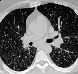 MRIOnline Imaging Mastery Series: Micronodules 2021 (Videos)