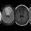 MRIOnline Imaging Mastery Series: Adult Glioma Imaging 2021 (Videos)