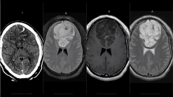 MRIOnline Imaging Mastery Series: Adult Glioma Imaging 2021 (Videos)