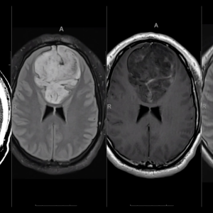 MRIOnline Imaging Mastery Series: Adult Glioma Imaging 2021 (Videos)