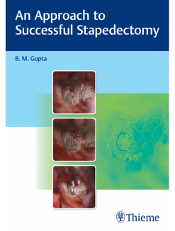 An Approach to Successful Stapedectomy (Original PDF from Publisher)