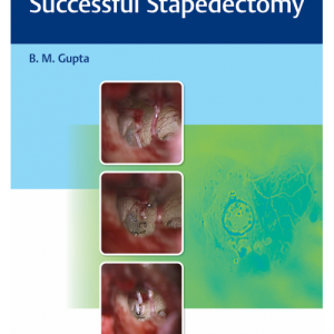 An Approach to Successful Stapedectomy (Original PDF from Publisher)