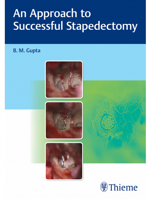 An Approach to Successful Stapedectomy (Original PDF from Publisher)