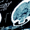 Stroke and Other Common Neurological Conditions 2019 (Videos)