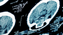 Stroke and Other Common Neurological Conditions 2019 (Videos)