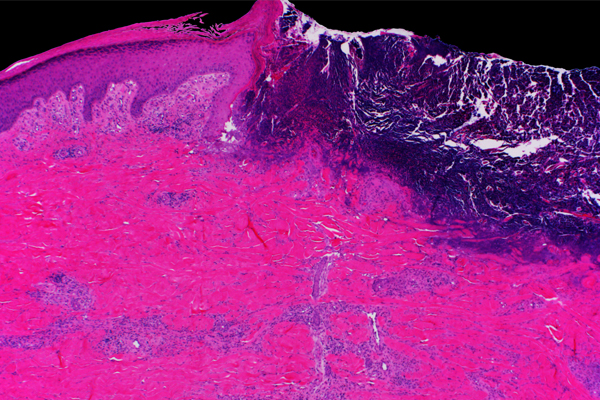 Mayo Clinic Wound Symposium: The Edges of Wound Care 2023 (Videos+Assessment Quiz)