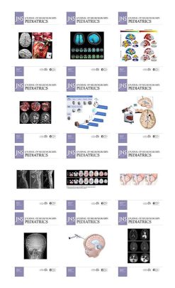 Journal of Neurosurgery: Pediatrics 2021 Full Archives (True PDF)
