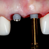 Online Residency Program: A-Z in Implant Dentistry 2021 (Videos)