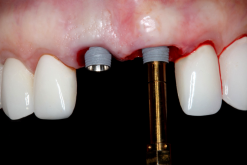 Online Residency Program: A-Z in Implant Dentistry 2021 (Videos)