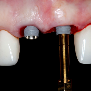 Online Residency Program: A-Z in Implant Dentistry 2021 (Videos)