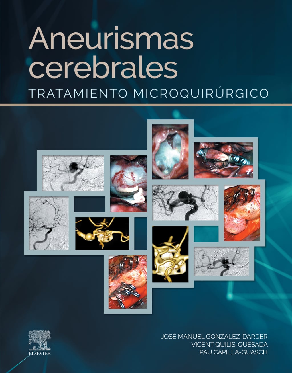 Aneurismas cerebrales: Tratamiento microquirúrgico (Original PDF from Publisher)