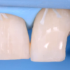 Gidedental Direct and Indirect Adhesive Restorations – Minimal Invasive Treatment of the Anterior and Posterior Damaged Dentition using Direct Bonded Restorations 2020 (Videos)