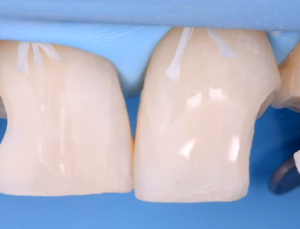 Gidedental Direct and Indirect Adhesive Restorations – Minimal Invasive Treatment of the Anterior and Posterior Damaged Dentition using Direct Bonded Restorations 2020 (Videos)