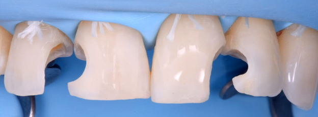 Gidedental Direct and Indirect Adhesive Restorations – Minimal Invasive Treatment of the Anterior and Posterior Damaged Dentition using Direct Bonded Restorations 2020 (Videos)