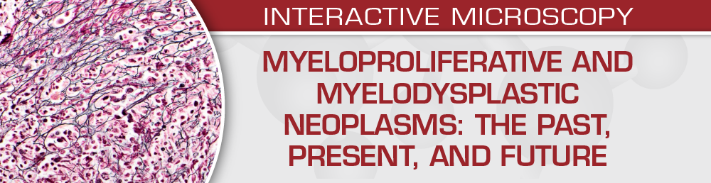 Myeloproliferative and Myelodysplastic Neoplasms: The Past, Present, and Future – USCAP (Videos)
