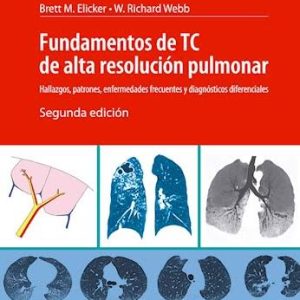Fundamentos De Tc De Alta Resolucion Pulmonar Hallazgos, 2ª edición (High Quality Image PDF)