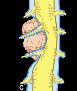 MRIOnline MRI Mastery Series: Extradural Lesions 2020 (Videos)