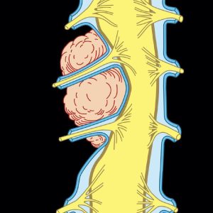 MRIOnline MRI Mastery Series: Extradural Lesions 2020 (Videos)