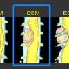MRIOnline MRI Mastery Series: Intradural Extramedullary Lesions (IDEM) 2020 (Videos)