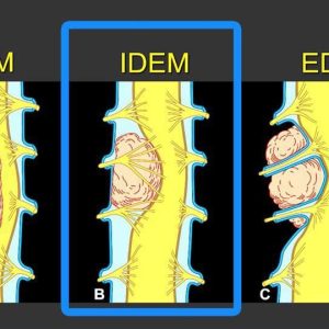 MRIOnline MRI Mastery Series: Intradural Extramedullary Lesions (IDEM) 2020 (Videos)