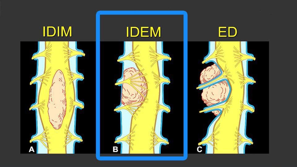 MRIOnline MRI Mastery Series: Intradural Extramedullary Lesions (IDEM) 2020 (Videos)