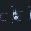 MRIOnline Mastery Series: Evaluation of Newly Diagnosed, Pre-Operative Breast Cancer Patients 2021 (Videos)