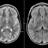 MRIOnline Mastery Series: Neurofibromatosis Type 1 (NF1) 2021 (Videos)