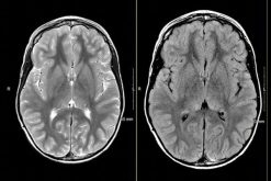 MRIOnline Mastery Series: Neurofibromatosis Type 1 (NF1) 2021 (Videos)