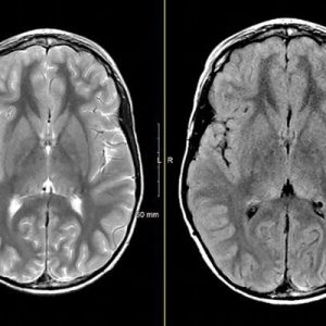 MRIOnline Mastery Series: Neurofibromatosis Type 1 (NF1) 2021 (Videos)