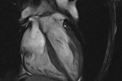 MRIOnline Mastery Series: Cardiac MRI of Non-Ischemic Cardiomyopathy 2021 (Videos)
