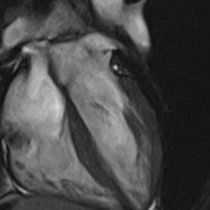 MRIOnline Mastery Series: Cardiac MRI of Non-Ischemic Cardiomyopathy 2021 (Videos)
