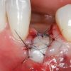 Gidedental Soft Tissue Management around Natural Teeth and Dental Implants 2020 (Videos)