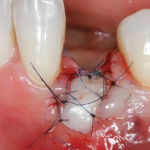 Gidedental Soft Tissue Management around Natural Teeth and Dental Implants 2020 (Videos)
