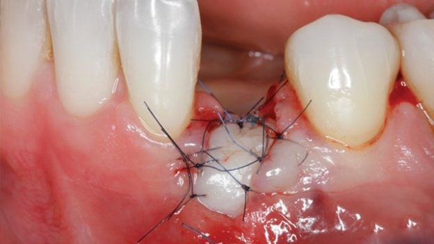 Gidedental Soft Tissue Management around Natural Teeth and Dental Implants 2020 (Videos)