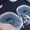 Neuroradiology Update 2016 – Online (Videos)